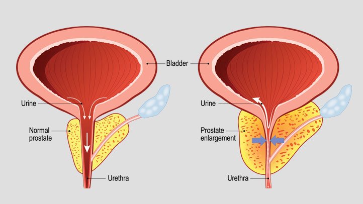 البروستاتا Prostatitis