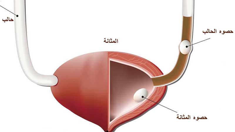 السفر للعلاج فى روسيا من حصوات الكلى و المسالك البولية