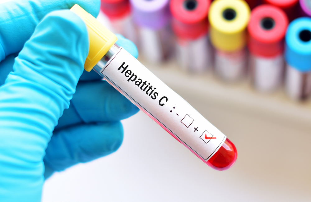 السفر للعلاج فى روسيا من التهاب الكبد الوبائي  Hepatitis C